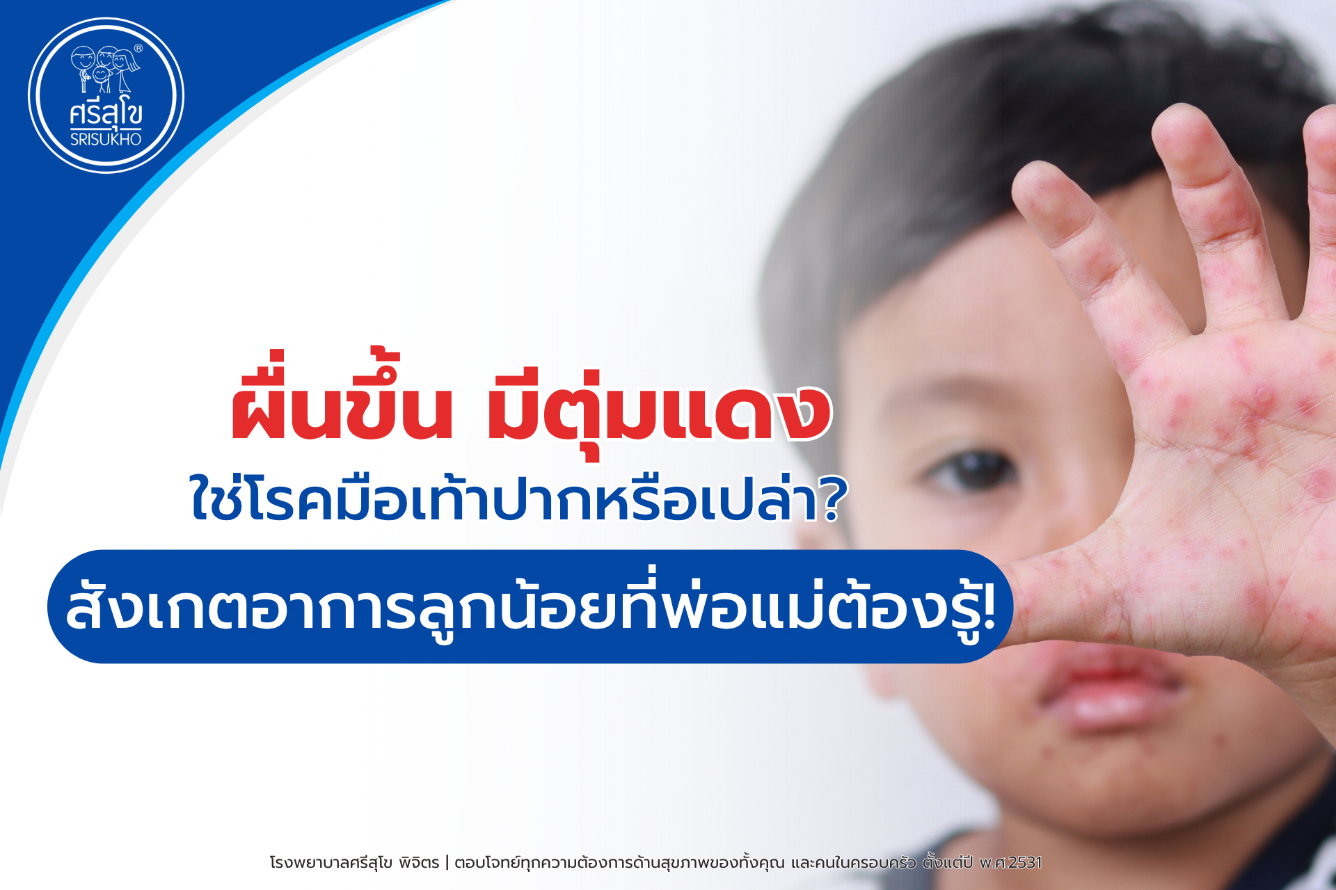 มือเท้าปากในเด็ก