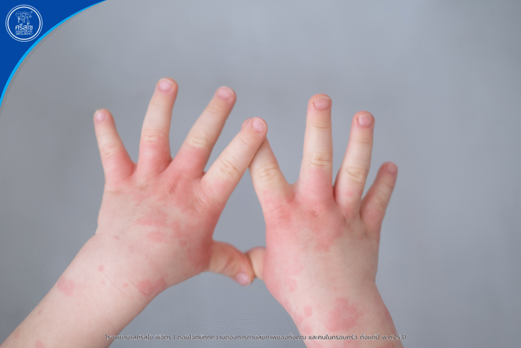Hand, foot and mouth disease symptoms-2