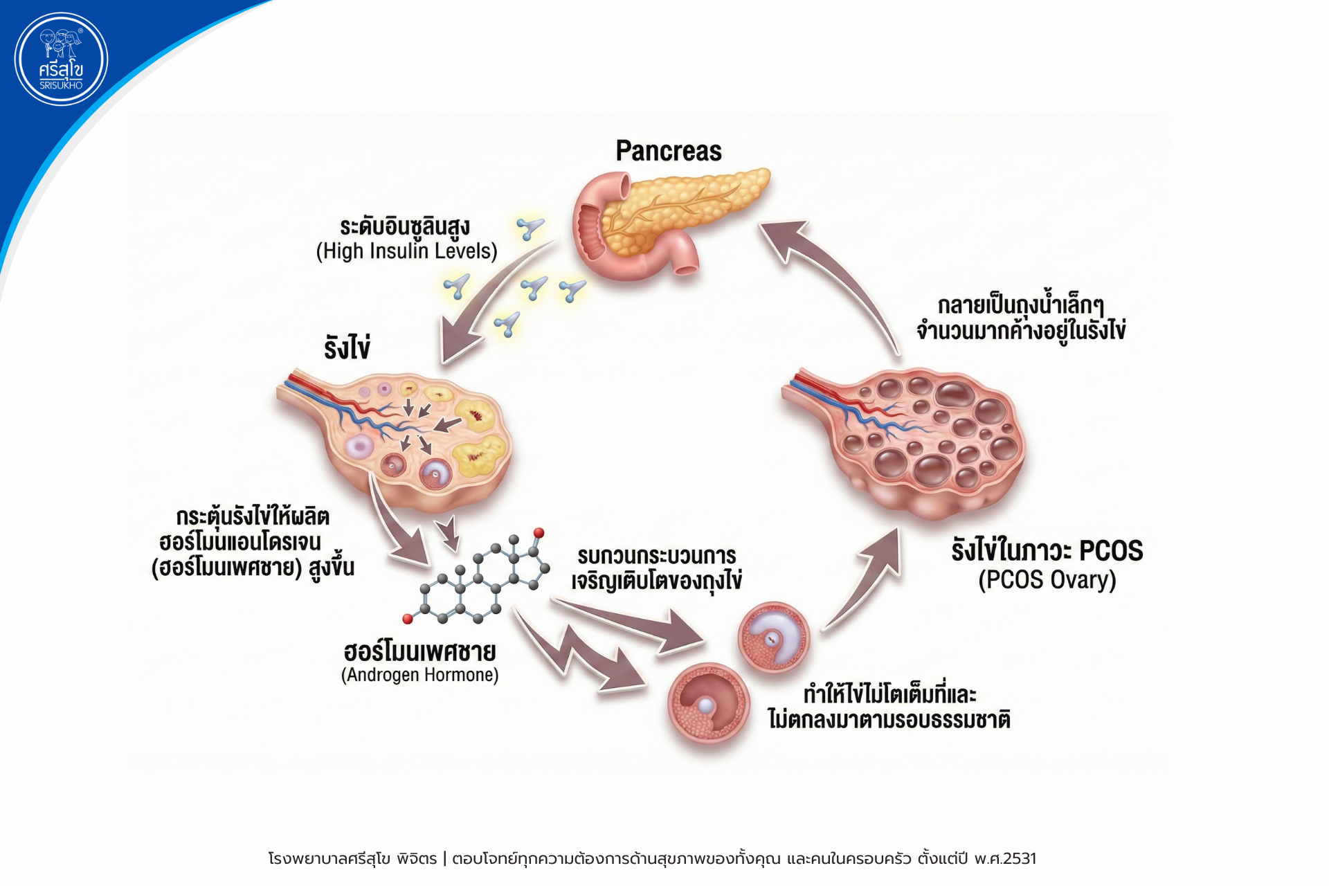 pcos-and-insulin-resistance-connection-1