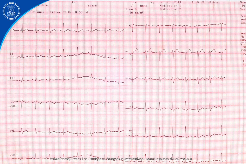 การตรวจคลื่นไฟฟ้าหัวใจ (EKG) คืออะไร